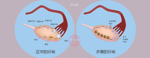 正常卵巢 vs. 多囊卵巢 妈眯缘