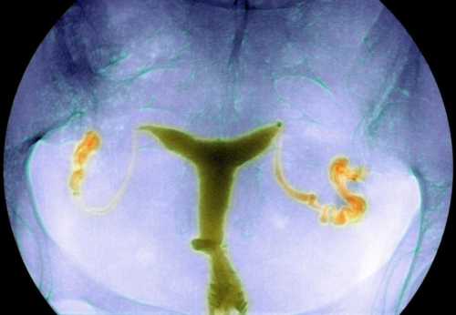 Blocked fallopian tubes, Fallopian tubes, 子宫输卵管碘油造影