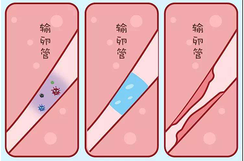 输卵管通而不畅
