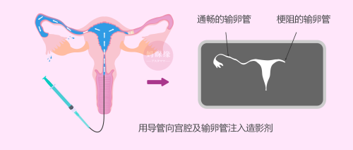 HSG 输卵管造影术 妈眯缘