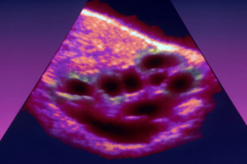 polycysticovarysyndrom PCOS 多囊患者B超表现