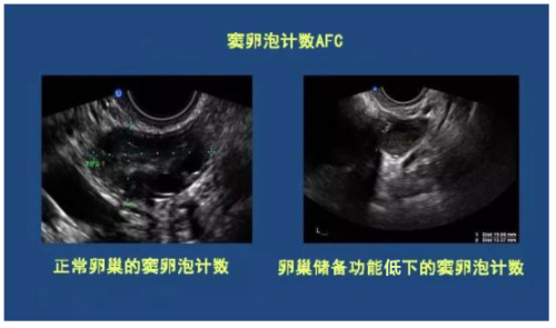 正常卵巢的窦卵泡技术 卵巢储备功能低下的窦卵泡计数.png