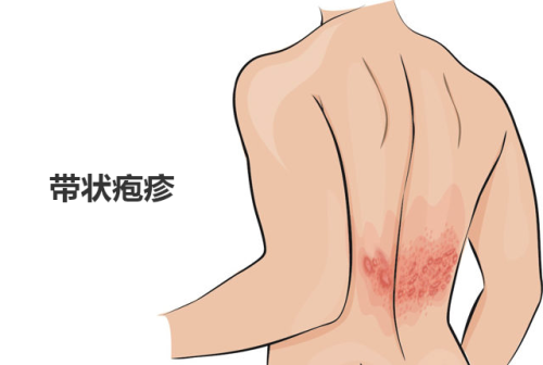 带状疱疹 herpes zoster 01.png