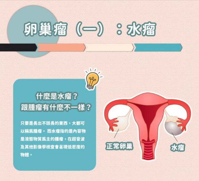卵巢囊肿