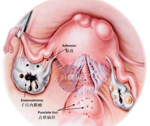 endometriosis 001 妈眯缘