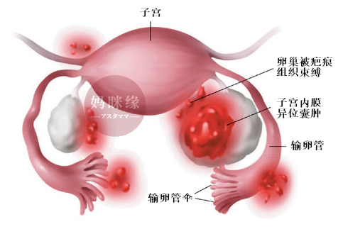 子宫内膜异位症 卵子受阻碍 妈眯缘.jpg