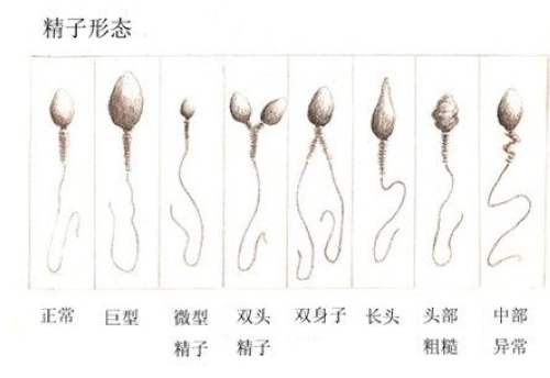 精子 畸形精子症