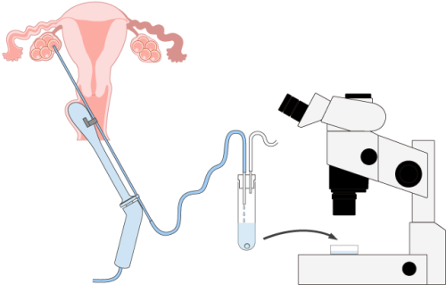 抽吸单个卵泡 Aspirate a single dominant follicle