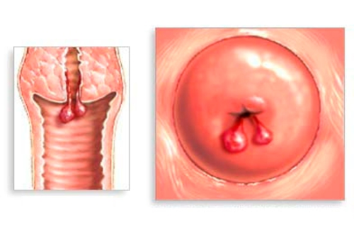 子宫颈息肉 Cervica polyps
