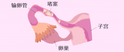 输卵管堵塞 Fallopian tube blockage 002_1.png
