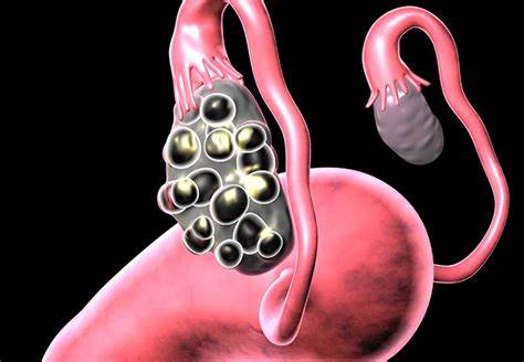 多囊卵巢综合征 PCOS 3D渲染.jpg