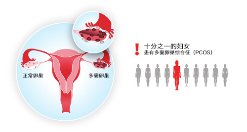 多囊卵肠综合征 PCOS 发病率 妈眯缘.png