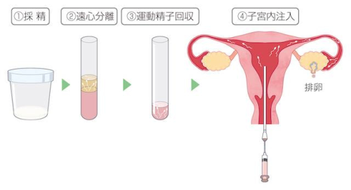IUI 人工授精 005.png