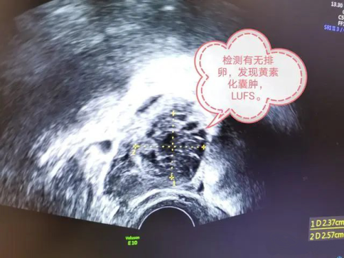 黄体化未破裂卵泡综合征 B超 LUFS.png
