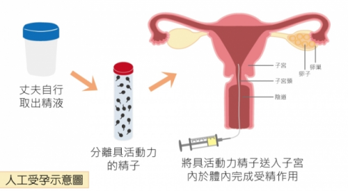 人工授精的过程 人工受孕 示意图.png