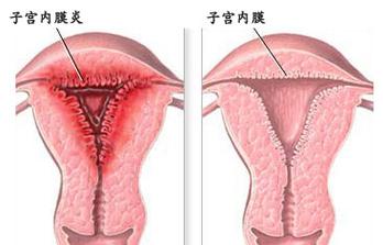 子宫内膜炎 (1).jpg