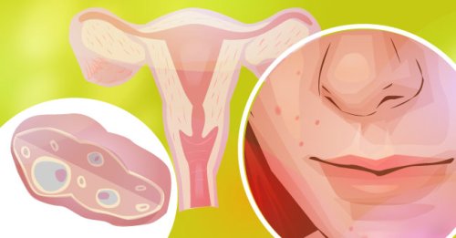 多囊卵巢综合症是一种非常缠人的疾病