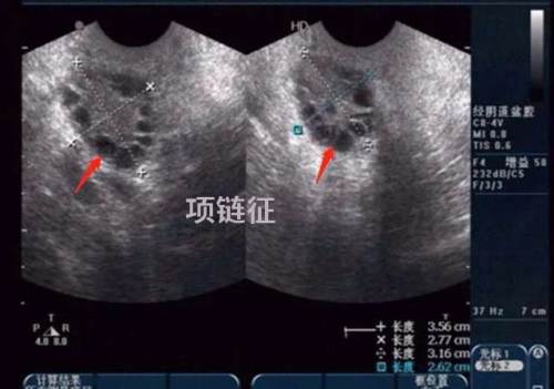 B超 卵巢多囊样改变 项链征