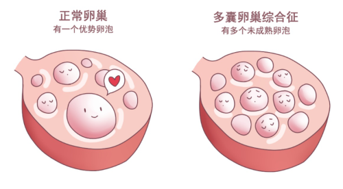 正常卵巢 vs 多囊卵巢综合征 002_1.png
