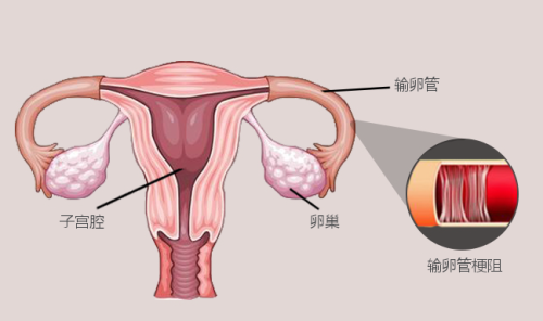 fallopian tube test 输卵管官腔梗阻