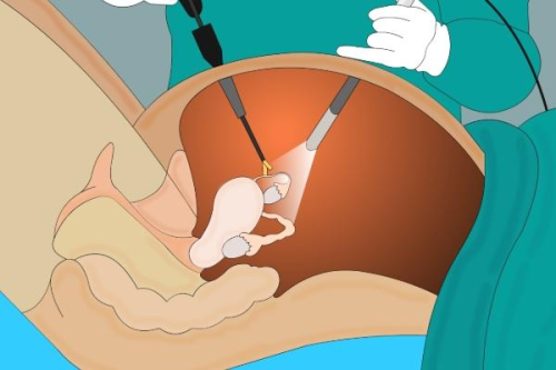宫腔镜输卵管疏通的过程 腹腔镜、宫腔镜联合输卵管通液术