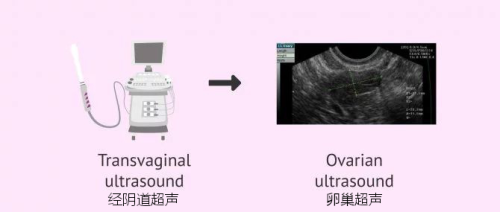 经阴道超声扫描窦卵泡计数 ovarian-ultrasound-670x285.jpg.png