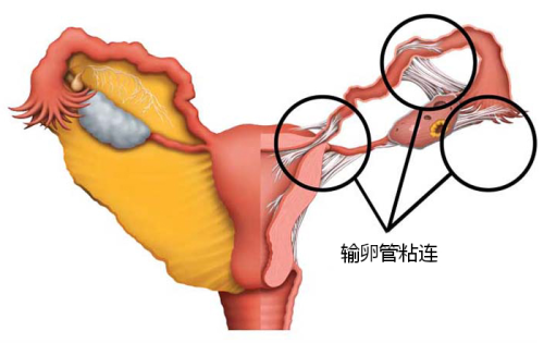 输卵管粘连001