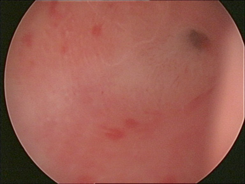 输卵管镜 左输卵管口 left tubal ostium