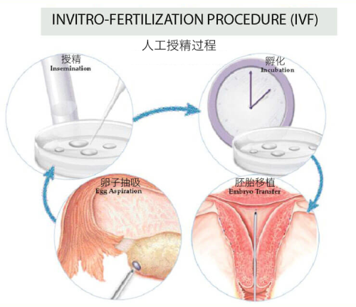 试管婴儿 过程 IVF procedure