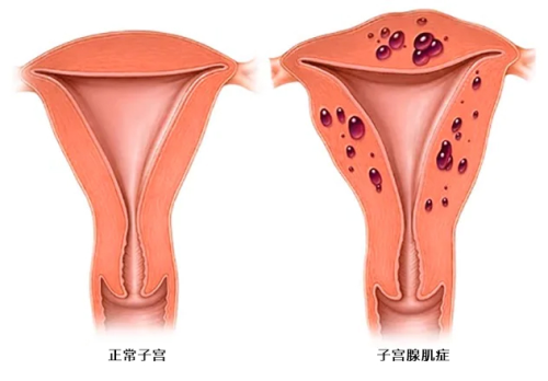 子宫腺肌症 adenomyosis 正常子宫.png