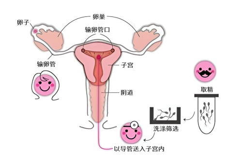 IUI intrauterine insemination 001.png