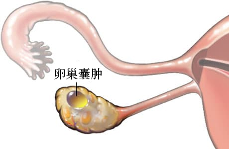 卵巢囊肿 002.jpg